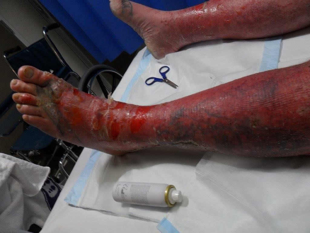 &quot;Whole Sheets Of Skin Were Falling Off&quot; Burns Victim's Incredible